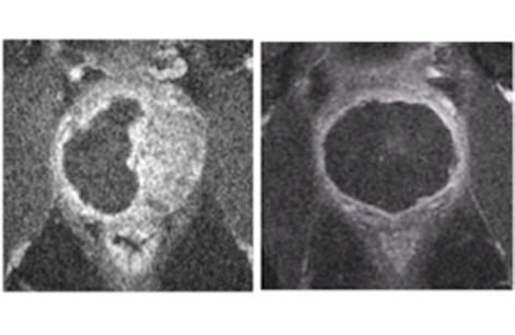 Cancer de la prostate : le TOOKAD soluble de Weizmann (Israël), approuvé au Mexique suite à une étude en Europe